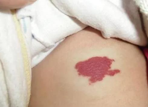鲜红斑痣的病因是什么?E光治疗鲜红斑痣有什么副作用?