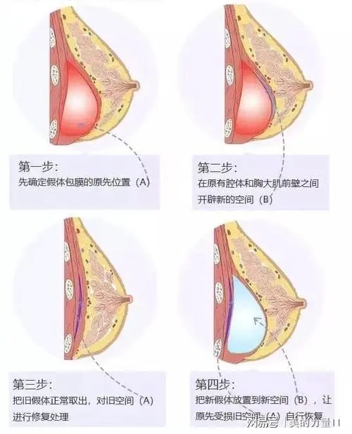 上海丰胸的价格是多少?丰胸手术有哪些方法?