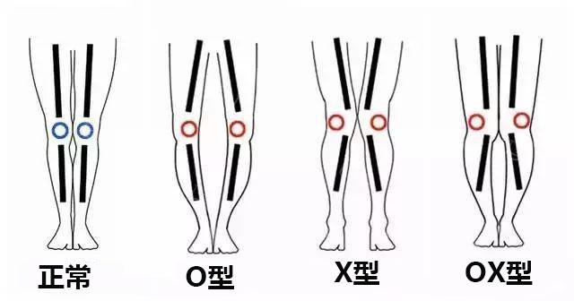 大多数人不是O型腿就是X型腿，腿型矫正必看