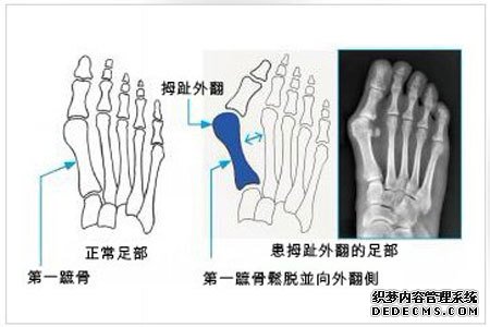 大脚骨保守治疗