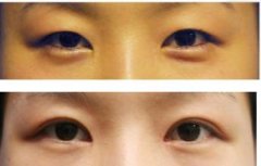 韩式双眼皮和切开法双眼皮有什么不同
