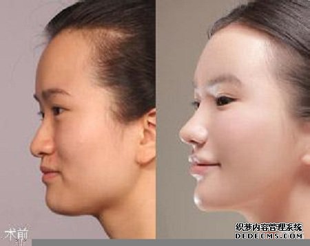 综合鼻整形可以改善哪些鼻型