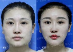 北京做下颌角磨骨手术多少钱呢