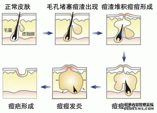 激光祛痘手术后的注意事项是什么